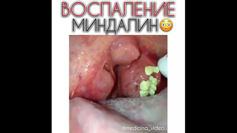 Воспаление миндалин приятного просмотра, у кого болит горло