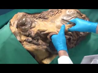 Anatomy on the table peritoneal structures and relations – an overview