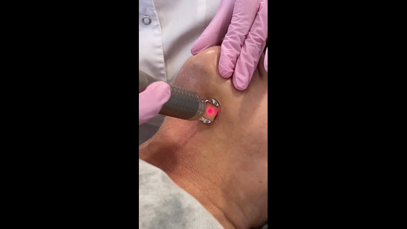 Лазерный пилинг