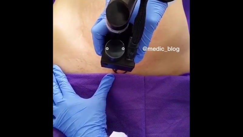 Косметическая лазерная процедура по удалению шрама