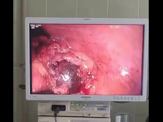 Лапароскопическая резекция кисты почки