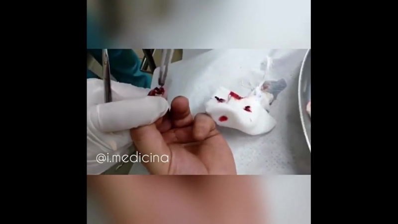 Хирургическая обработка рваной раны пальца