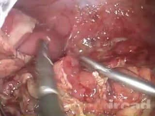 Postoperative peritonitis caused by thermal injury during laparoscopic colectomy lesson learned laparoscopic surgery on the