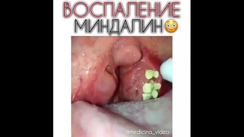 Воспаление миндалин