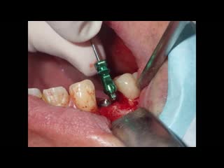 Alveolar preservation and tsv zimmer dental implant upper right