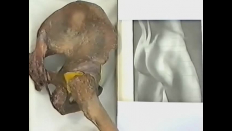 Топографическая анатомия ягодичной области