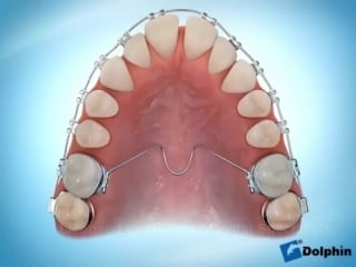 Trans palatal arch (tpa) dr port dr klein, gurnee vernon hills orthodontists ортодонтия