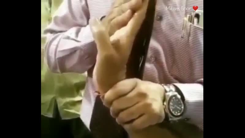 Демонстрация примера двигательного расстройства (тремора) кисти