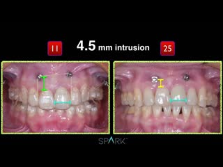 My perspective on digital orthodontics part 1 ортодонтия