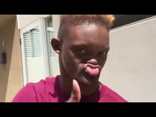 Эктодермальная дисплазия