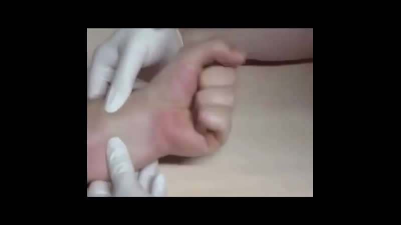 Тест аллена для оценки коллатерального кровообращения в кисти