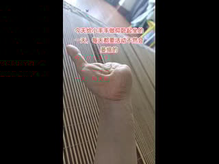 Ампутация 4 х пальцев кисти