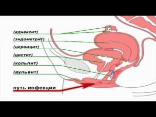 Гинекология скрытые инфекции