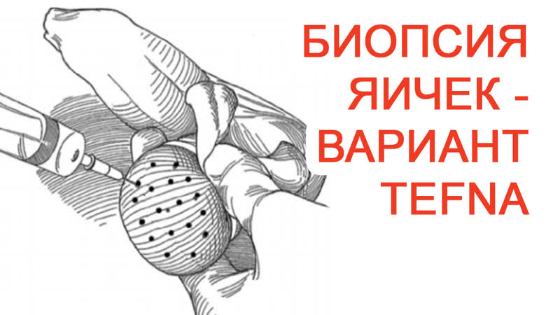 Биопсия яичек вариант tefna