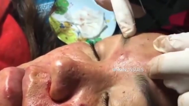 Акне