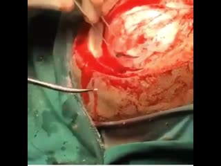 Трепанация черепа