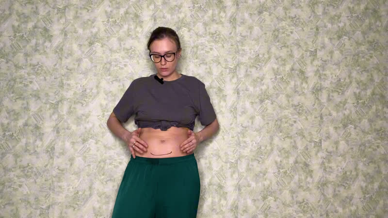 Боюсь трогать шов от кс самомассаж рубца после кесарева сечения (массаж подходит для всех видов шрамов)