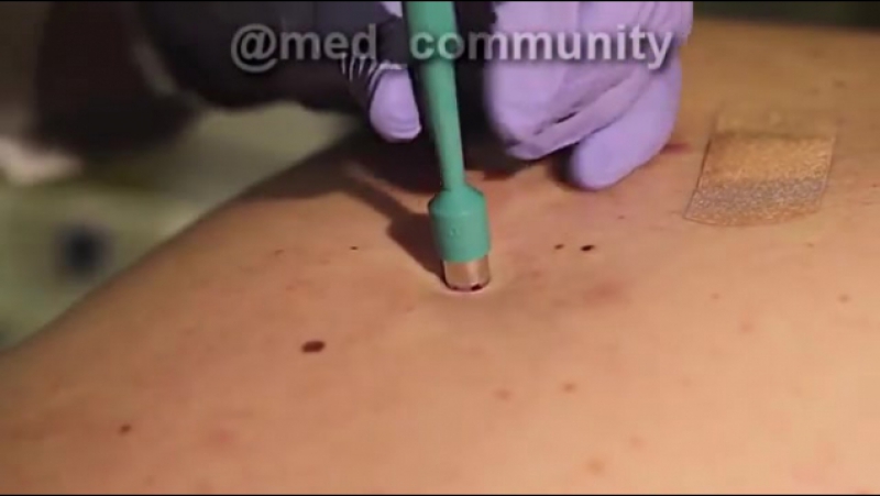 Биопсия кожи