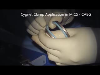 Use of cygnet in surgery mics/cabg