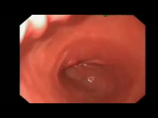 Перистальтические волны антрум желудка