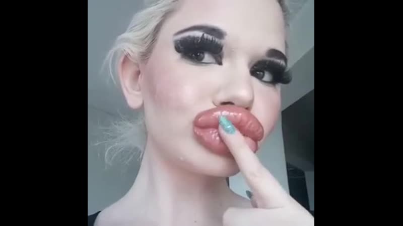 Обладательница самых больших губ мира снова их увеличила💋