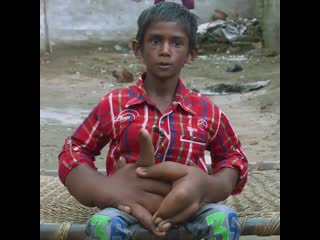 This boy's hands are 13 inches long, due to a mystery conditon he was born with now he's seeing a doctor for the first time