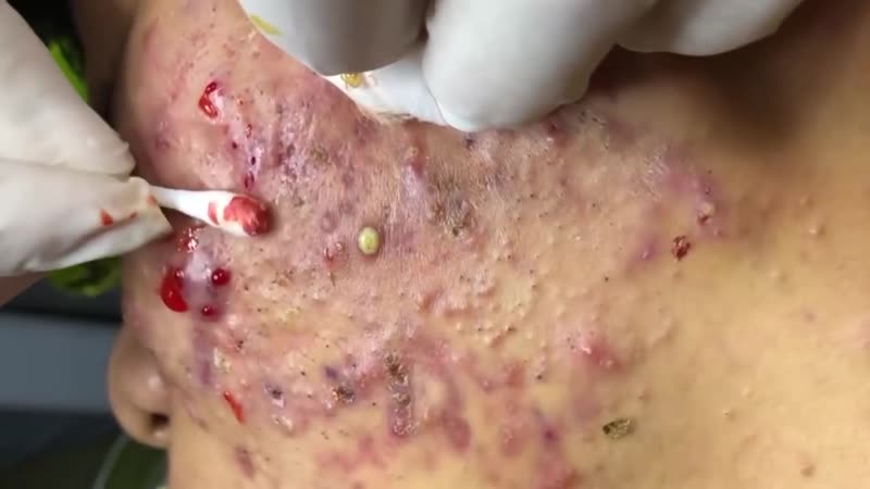 Воспаленные прыщи, корочки часть 3