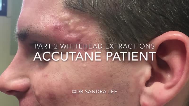 Большие белые угри