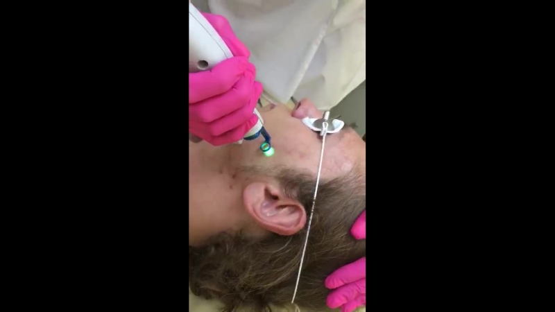 Видео процедуры по лазерному лечению акне