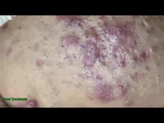 Чистка лица много черных точек, воспаленные прыщи