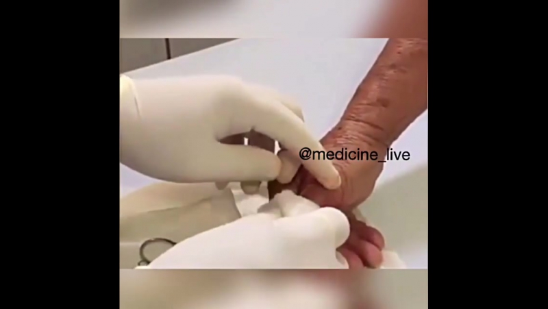 Онихомикоз грибковое поражение ногтя