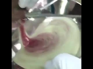 Разрез поднижнечелюстного абсцесса