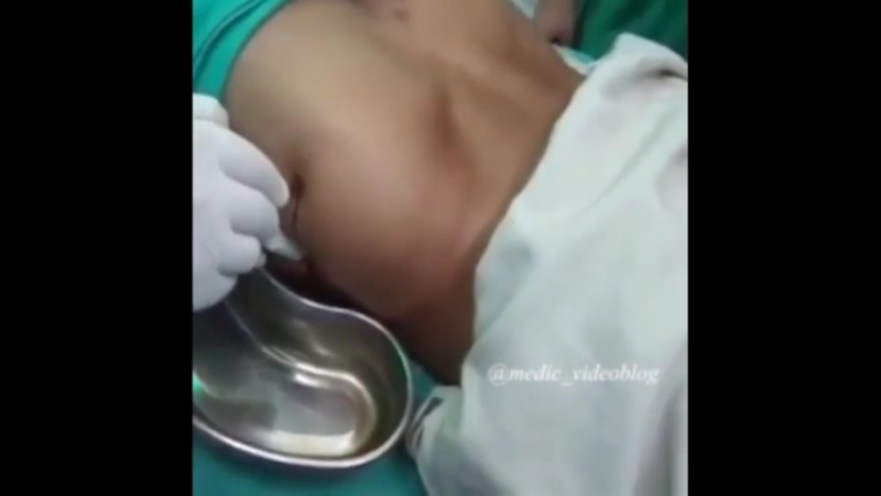 Вскрытие и дренирование абсцесса