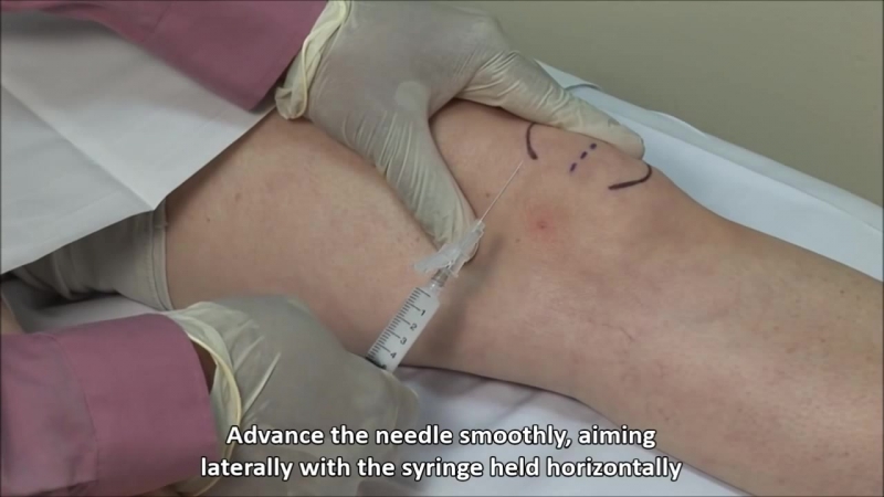 Инъекция в коленный сустав медиальный доступ