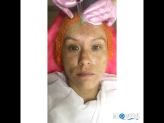 Мезотеоапия dermaheal sb