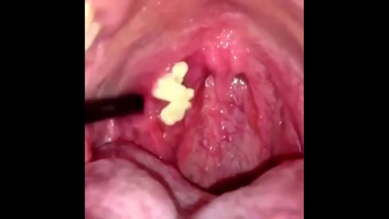 Огромное количество гнойного камня в миндалинах
