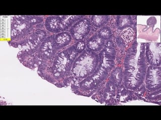 Дисплазия толстой кишки