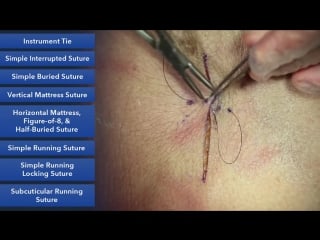 Vertical mattress suture suture techniques