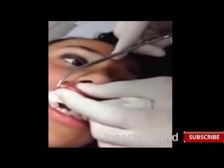 Insects inside the human body best of compilation2015