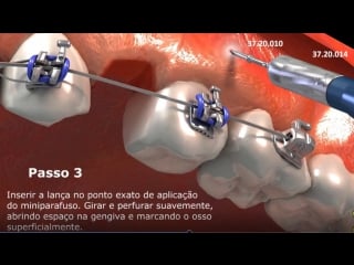 Mini implante morelli устаноа миниимпланта ортодонтия