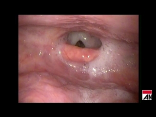 Airway on demand using peae to reveal moderate pharyngeal stenosis