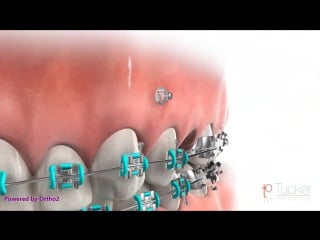 Orthodontic mini implant (tad or tsa) ортодонтия