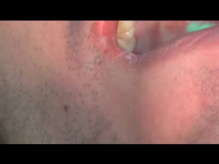 Anglevator #1 soft tissue impaction #16anglevator144