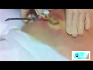 Вскрытие абсцесса