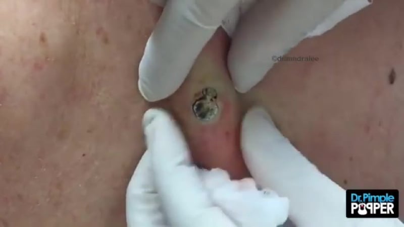 Расширенные загрязненные поры