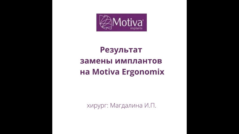 Результат замены имплантов на motiva ergonomix