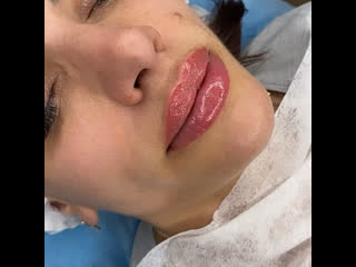 Контурная пластика губ