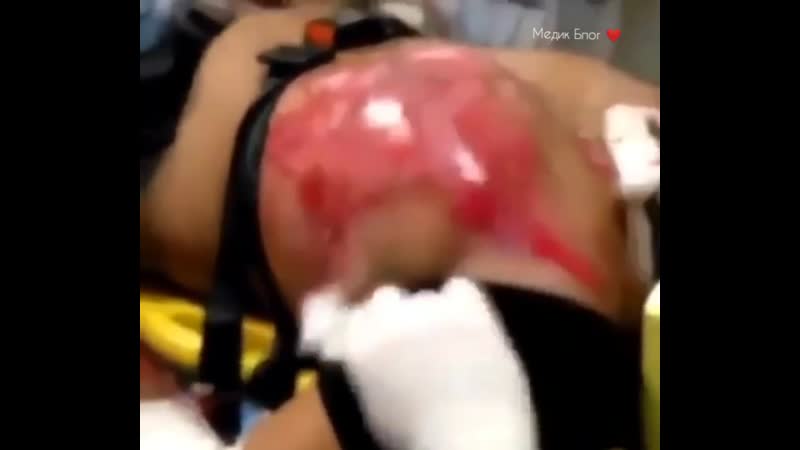 В больницу был доставлен пациент с флотирующей грудной клеткой