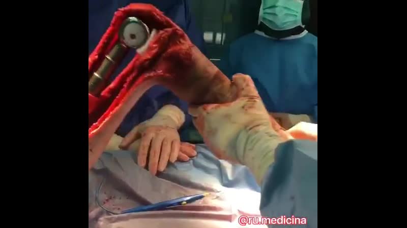 Эндопротезирование длинных трубчатых костей