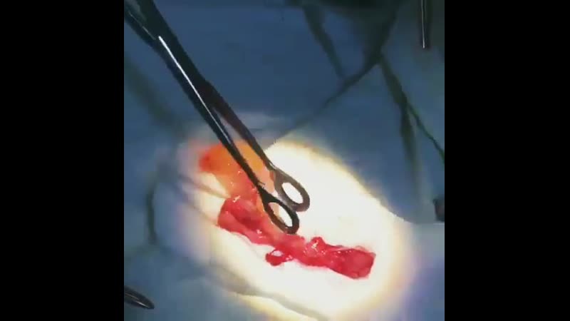 Выполнено удаление огромных размеров полипов носа